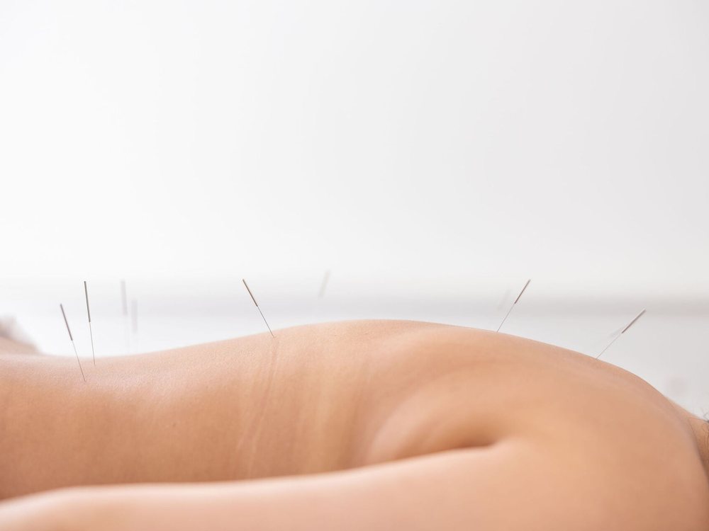 Acupuncture needles along a client's upper back Acupuncture needles along a client's upper back